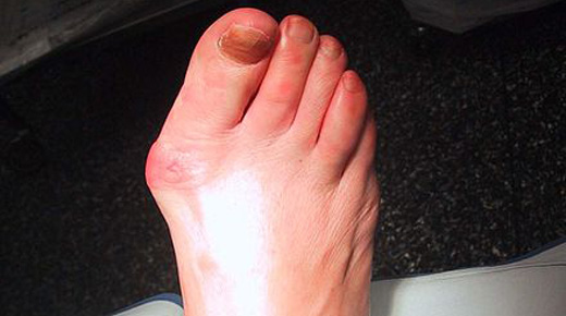 Hallux valgus & rigidus